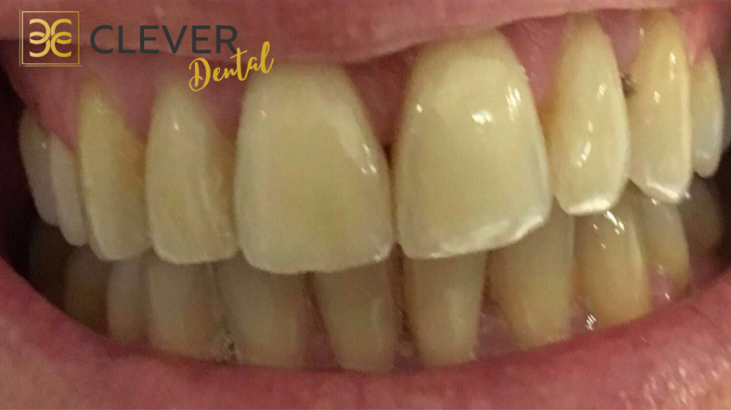 blanqueamiento-dental-sevilla-antes-y-despues-antes-1