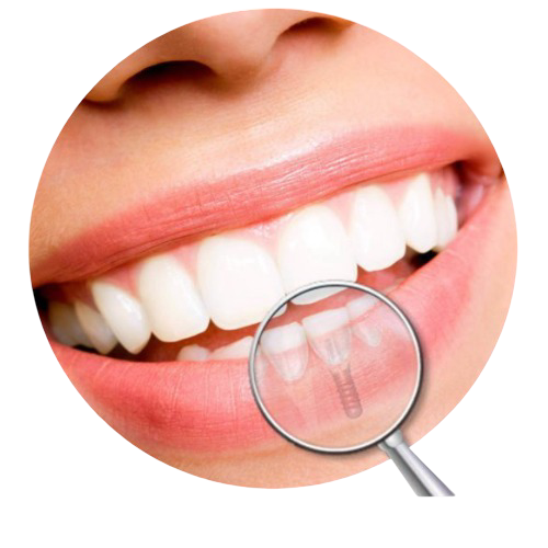 circulo-implantes dentales