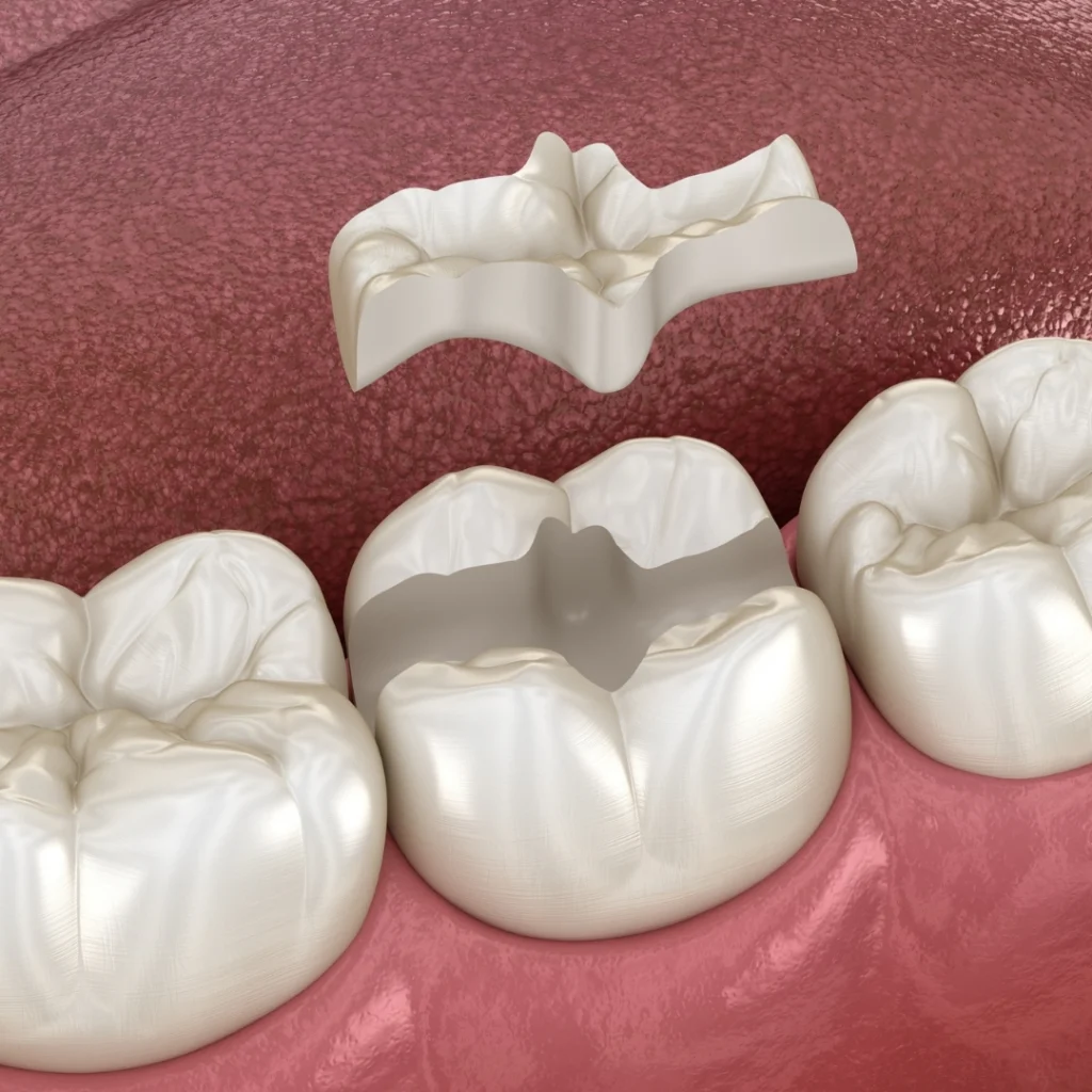 incrustaciones-dentales