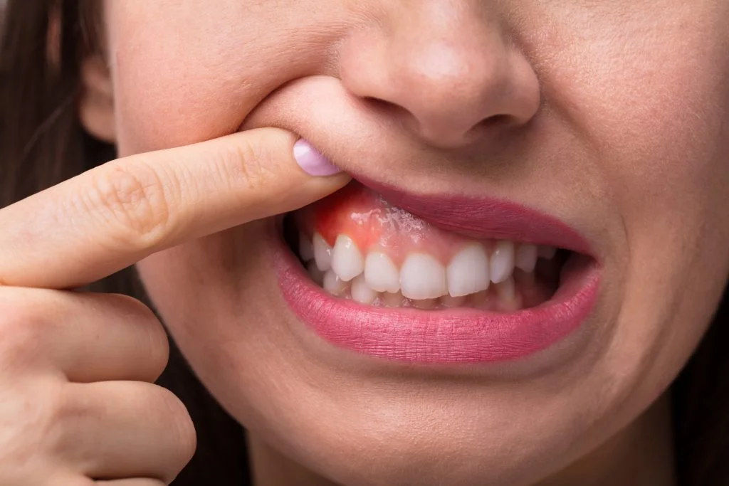 portada gingivectomia